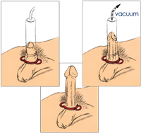 How to use pennis pump